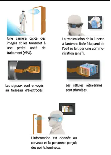 Innovation pour le traitement de la cécité au CHU de Bordeaux