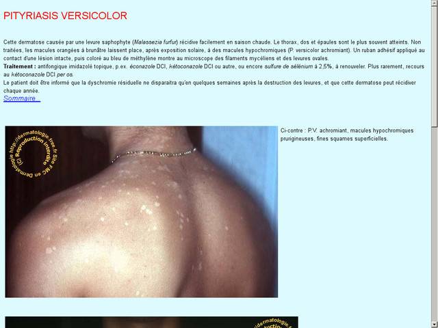 Cas cliniques pour la fmc - pityriasis versicolor