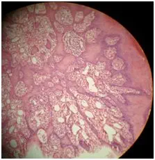 Un cas de papillome trachéal : aspect diagnostique et thérapeutique