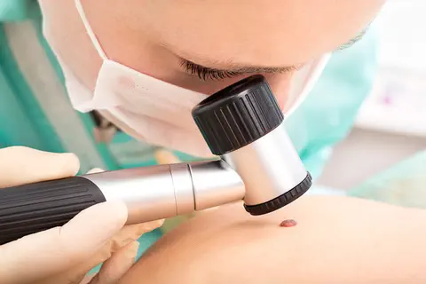 Compter le nombre de grains de beauté sur le bras droit pour évaluer les risques de cancer de la peau ? 