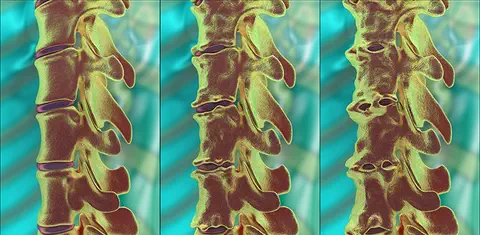 Cosentyx® (secukinumab) obtient deux extensions d’AMM dans deux indications : la spondylarthrite ankylosante et le rhumatisme psoriasique