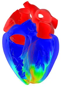 Cœurs personnalisés simulés en 3D : le projet Living Heart de Dassault Systèmes accessible dans le cloud 