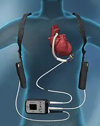 Insuffisance cardiaque sévère : Le laboratoire Abbott lance le Heartmate 3™ 