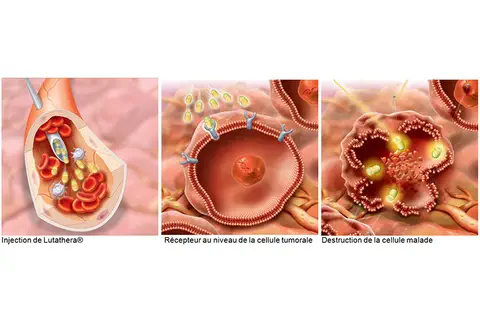 Innovation en cancérologie : un traitement ciblé pour les tumeurs de l’intestin grêle