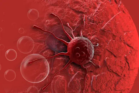 Tumeurs de la vessie superficielles : l’IPC a traité son 30e patient avec la thermochimiothérapie