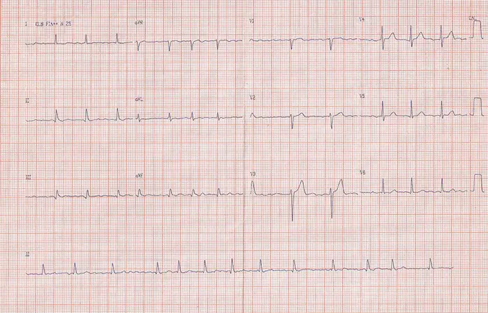 Arythmie cardiaque : une approche nouvelle