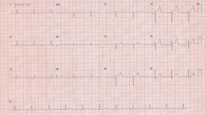 Arythmie cardiaque : une approche nouvelle