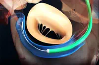 De nouvelles données montrent que le Carillon Mitral Contour System® est associé à une amélioration du volume de régurgitation chez les patients atteints d’une augmentation du tenting de la valve mitrale