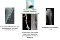 Un implant fémoral chargé en antibiotique pour traiter une infection osseuse chronique