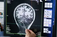 L’intelligence artificielle au service de l’épilepsie pharmacorésistante