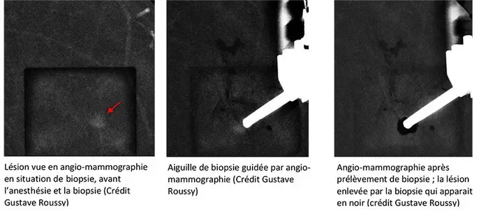 Une biopsie du sein guidée par angiomammographie : une première mondiale signée Gustave Roussy