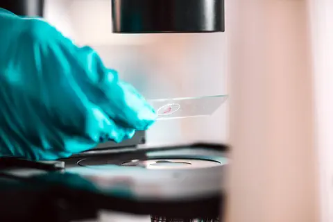1ère administration d’UCART22 à un patient ayant la leucémie lymphoblastique aiguë à cellules B en rechute ou réfractaire
