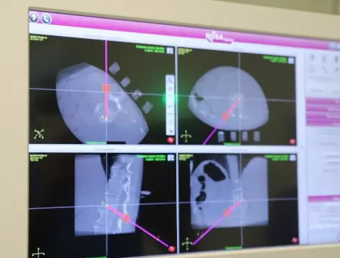 Première mondiale en Rhumatologie : Une biopsie rachidienne sous assistance robotisée pour infection sévère de vertèbres