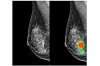 Les radiologues assistés par l’IA peuvent détecter davantage de cancers du sein avec une réduction des rappels de faux positifs