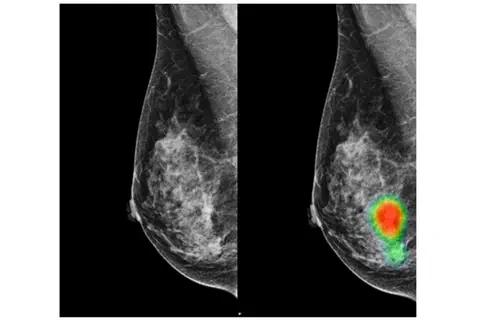 Les radiologues assistés par l’IA peuvent détecter davantage de cancers du sein avec une réduction des rappels de faux positifs