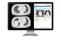 icometrix lance la première solution certifiée CE basée sur l’IA pour l’analyse de scanner thoracique dans la lutte contre le COVID-19