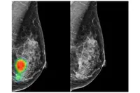 Lunit INSIGHT MMG, une solution d’IA pour la détection du cancer du sein, désormais agréé CE