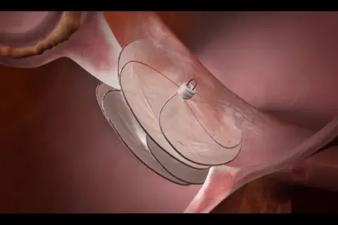 La fermeture du FOP à l’aide de l’obturateur septal GORE® CARDIOFORM permet de réduire de manière sûre et à long terme les récidives d’accidents vasculaires cérébraux