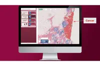 Digitaliser les services d’Anatomie et Cytologie pour mieux soigner les cancers 