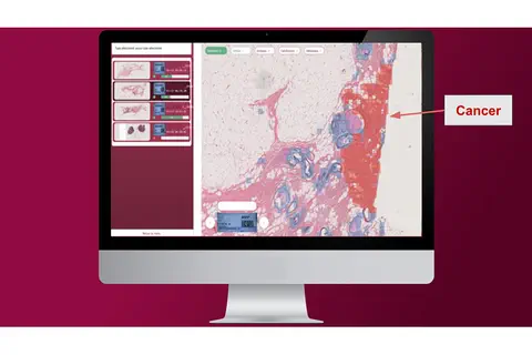 Digitaliser les services d’Anatomie et Cytologie pour mieux soigner les cancers