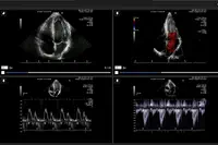 L’essai multicentrique international FAST II confirme la haute précision diagnostique de la solution CAAS vFFR de Pie Medical Imaging