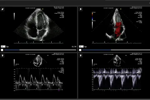 L’essai multicentrique international FAST II confirme la haute précision diagnostique de la solution CAAS vFFR de Pie Medical Imaging