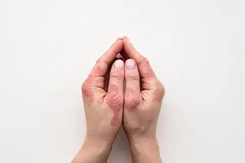 Psoriasis en plaques modéré à sévère : feu vert européen pour BIMZELX®▼(bimekizumab) d’UCB
