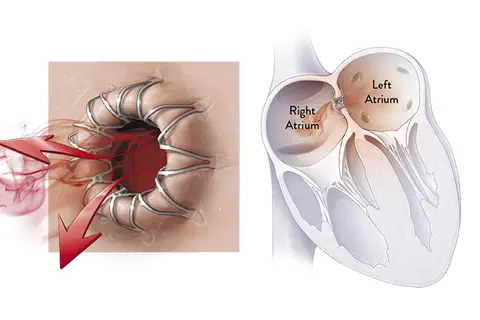 Insuffisance cardiaque : l’essai historique REDUCE LAP-HF II  démontre les bénéfices cliniques du shunt auriculaire de Corvia®