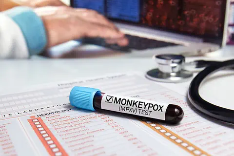 Monkeypox : les médecins de plus en plus préoccupés par la désinformation