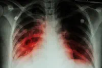 Tuberculose : les cas et les décès sont repartis à la hausse pendant la pandémie de Covid-19
