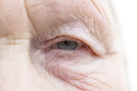 DMLA : Aviceda Therapeutics reçoit l’autorisation de la FDA pour les essais cliniques de phase 2 de l’AVD-104