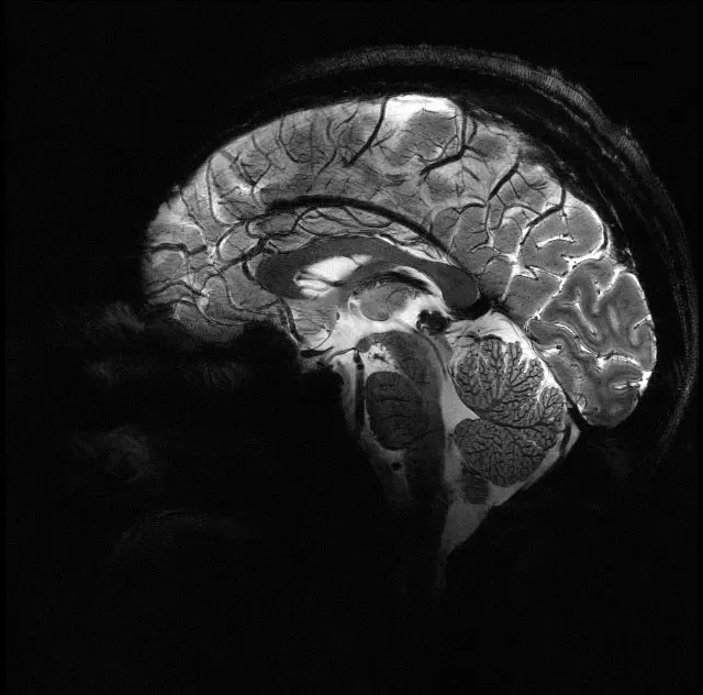 L’IRM Iseult révèle le cerveau avec une précision sans précédent