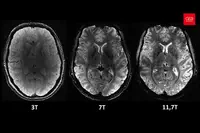 L’IRM Iseult révèle le cerveau avec une précision sans précédent